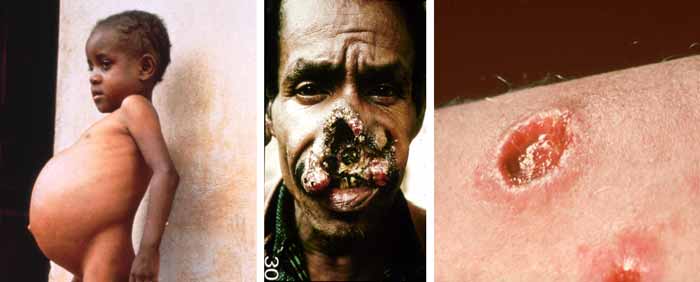 leishmaniasis%20trio.jpg